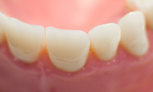 Dental veneers Southend-on-Sea, Essex